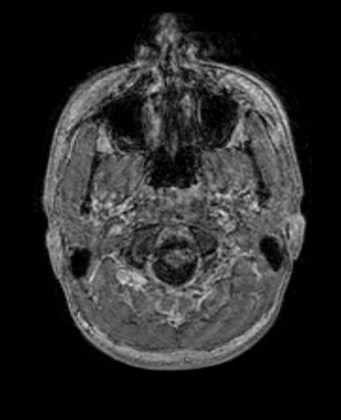File:Arachnoid cyst- extremely large (Radiopaedia 68741-78451 Axial T1 C+ 8).jpg