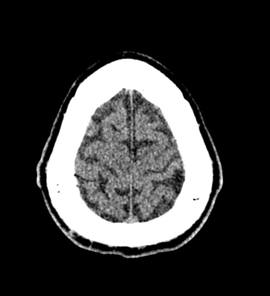 File:Arachnoid cyst of the ambient cistern (Radiopaedia 81301-94986 Axial non-contrast 63).jpg