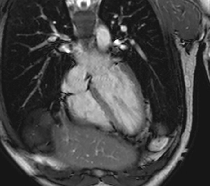 File:Arrhythmogenic right ventricular cardiomyopathy (Radiopaedia 39806-42237 D 106).jpg