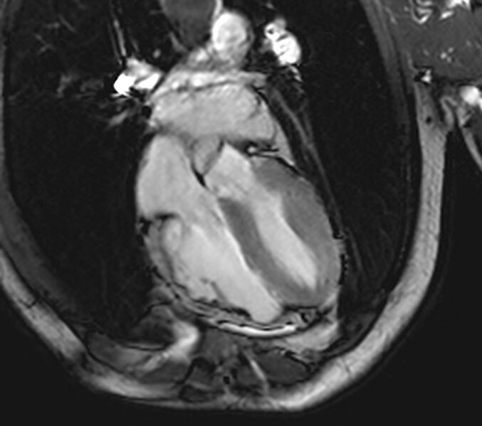 File:Arrhythmogenic right ventricular cardiomyopathy (Radiopaedia 39806-42237 D 11).jpg