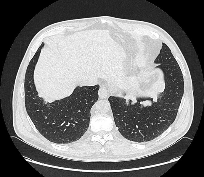 File:Asbestos pleural placques (Radiopaedia 57905-64872 Axial lung window 194).jpg