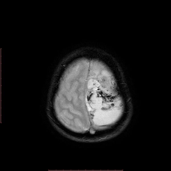 File:Astroblastoma (Radiopaedia 74287-85162 Axial SWI 20).jpg
