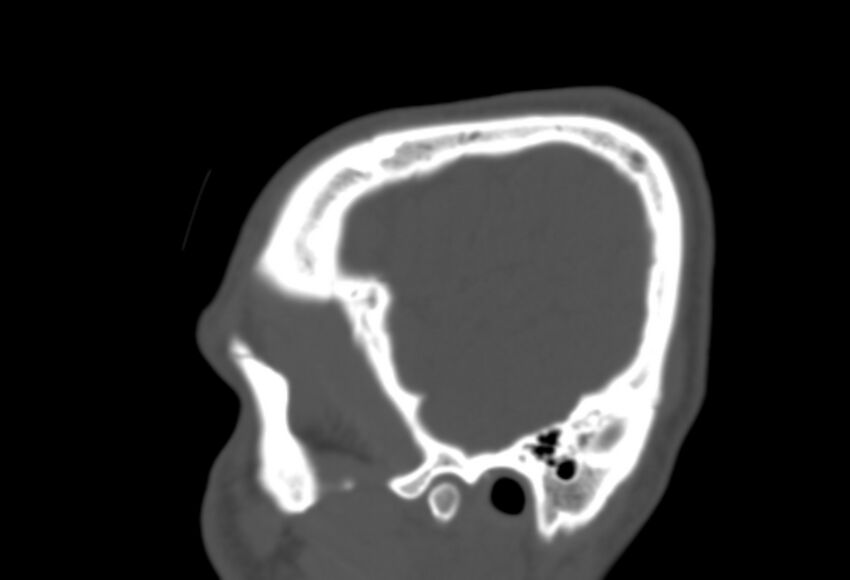 Asymptomatic occipital spur (Radiopaedia 87753-104201 Sagittal bone window 25).jpg