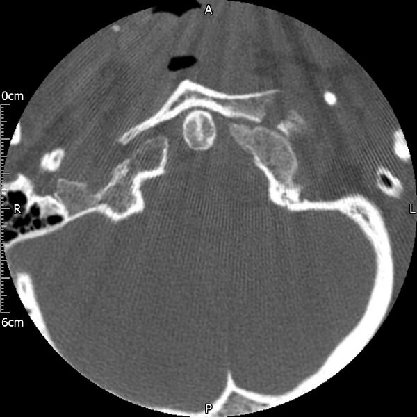 File:Atlas fracture with Currarino type A congenital defect (Radiopaedia 71747-82144 Axial bone window 19).jpg