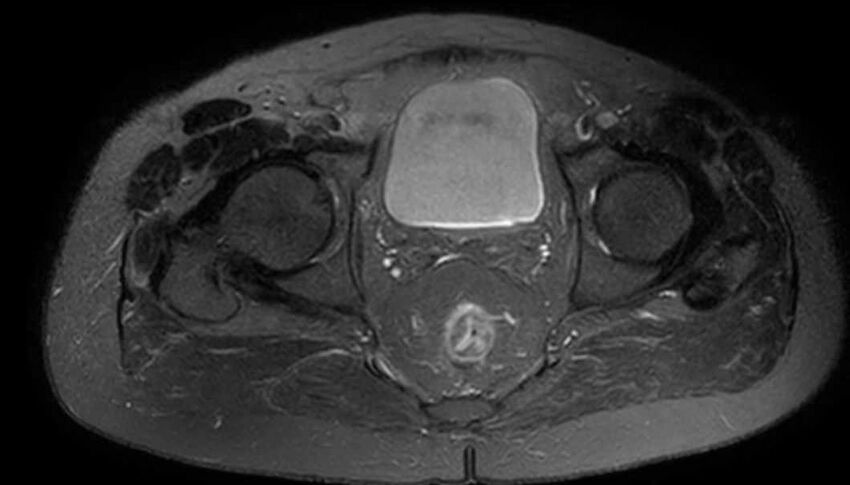 Atypical lipomatous tumor - thigh (Radiopaedia 68975-78734 Axial T2 fat sat 94).jpg