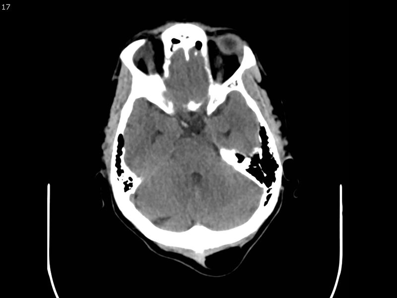 File:Atypical meningioma - intraosseous (Radiopaedia 64915-73867 A 17).jpg