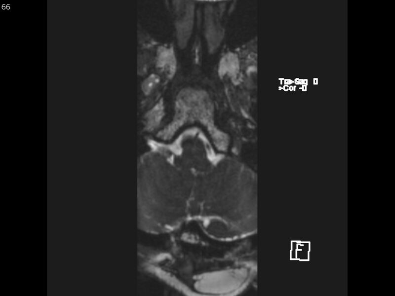 File:Atypical meningioma - intraosseous (Radiopaedia 64915-74572 Axial CISS 66).jpg