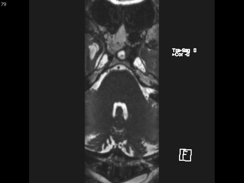 File:Atypical meningioma - intraosseous (Radiopaedia 64915-74572 Axial CISS 79).jpg