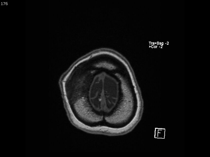 Atypical meningioma - intraosseous (Radiopaedia 64915-74572 Axial T1 176).jpg
