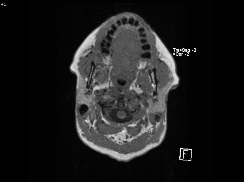 Atypical meningioma - intraosseous (Radiopaedia 64915-74572 Axial T1 41).jpg