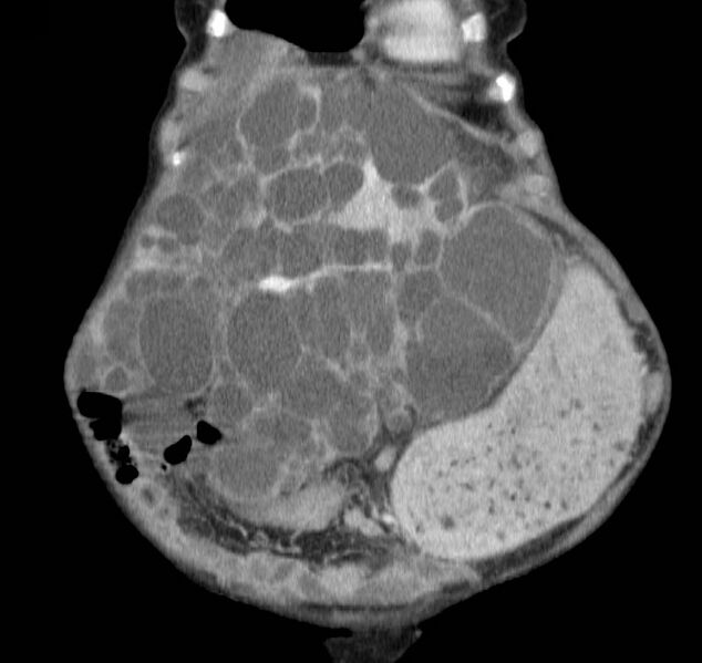 File:Autosomal dominant polycystic kidney disease (Radiopaedia 16777-16490 B 7).jpg