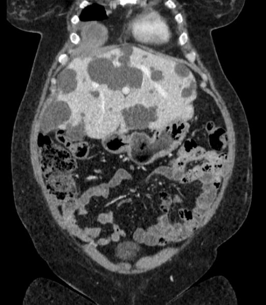 File:Autosomal dominant polycystic kidney disease (Radiopaedia 57124-64017 B 20).jpg