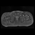 Avascular necrosis of the hip (Radiopaedia 29563-30067 Axial T1 C+ fat sat 12).jpg