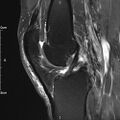 Avulsion fracture of the fibular head (Radiopaedia 74804-85808 Sagittal PD fat sat 18).jpg