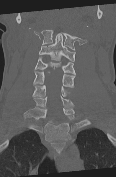 File:Axis peg fracture (type 3) and atlas lateral mass (type 4) fracture (Radiopaedia 37474-39324 Coronal bone window 21).png