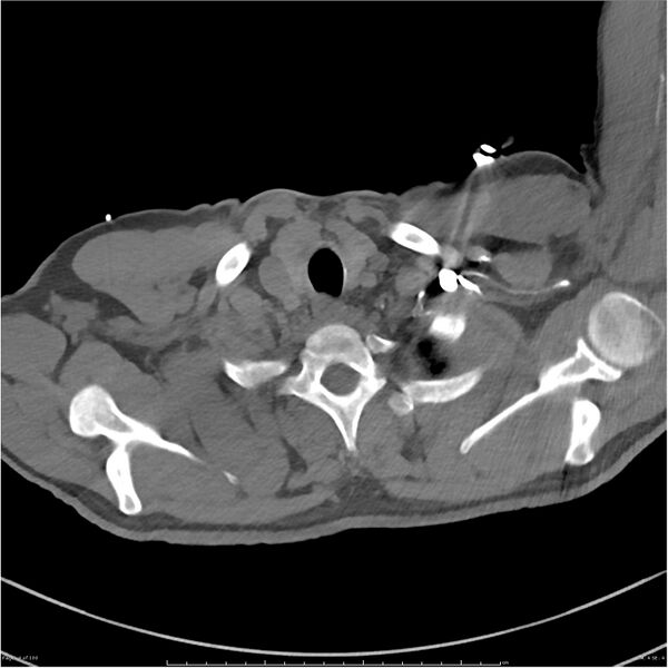 File:Azygos venous system anatomy (CT pulmonary angiography) (Radiopaedia 25928-26077 Axial C+ CTPA 4).jpg