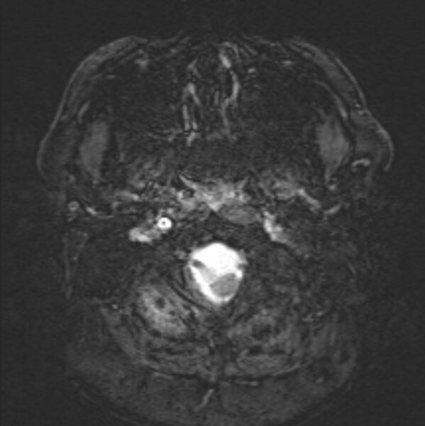 File:Basilar artery dissection (Radiopaedia 77032-88976 Axial SWI 3).jpg