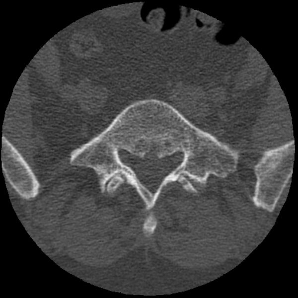File:Bertolotti syndrome (Radiopaedia 24864-25128 Axial bone window 12).jpg