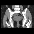 Bicornuate uterus- on MRI (Radiopaedia 49206-54296 Coronal non-contrast 14).jpg
