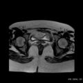 Bicornuate uterus- on MRI (Radiopaedia 49206-54297 Axial T2 13).jpg