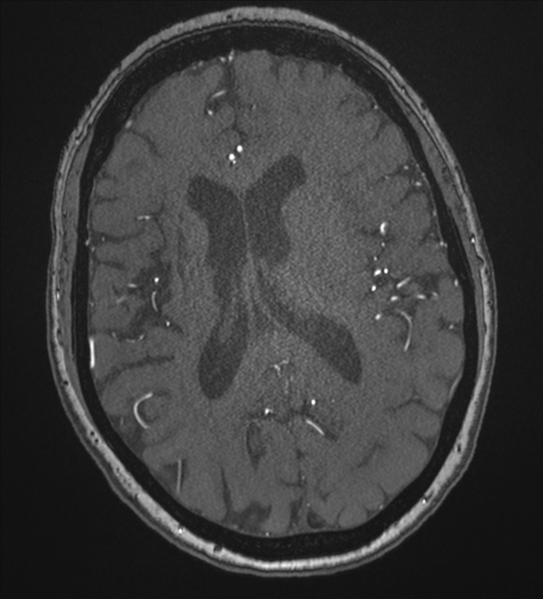File:Bilateral fetal posterior communicating arteries (Radiopaedia 41286-44102 Axial MRA 130).png