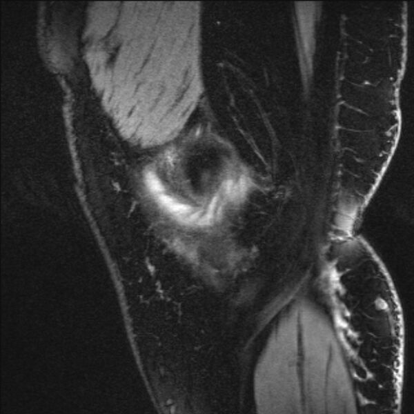 File:Bilateral focal pigmented villonodular synovitis (Radiopaedia 67643-77073 Sagittal T1 vibe 56).jpg