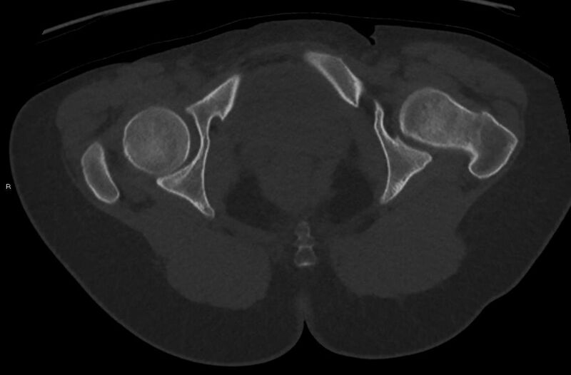 File:Bilateral mature cystic ovarian teratoma (Radiopaedia 88821-105592 Axial bone window 56).jpg