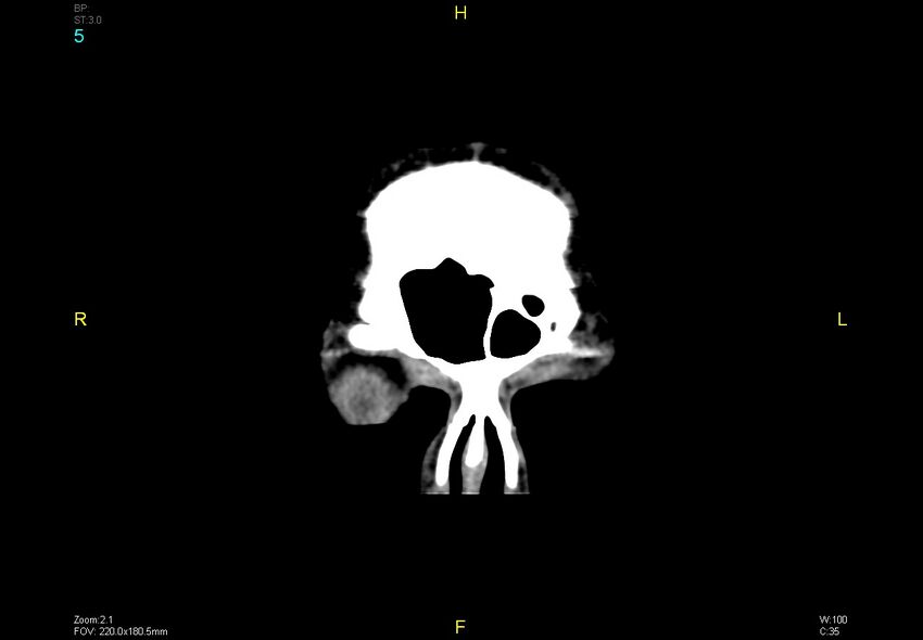 Bilateral medial medullary infarction (Radiopaedia 42220-45295 Coronal non-contrast 5).jpg