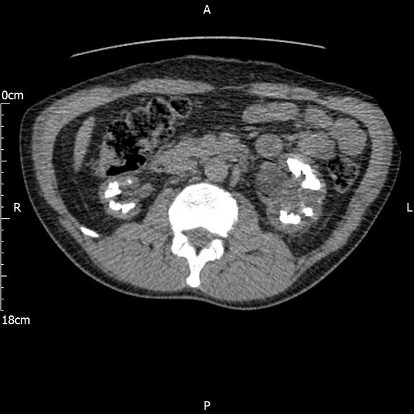 File:Bilateral medullary nephrocalcinosis with ureteric calculi (Radiopaedia 71269-81569 Axial non-contrast 48).jpg