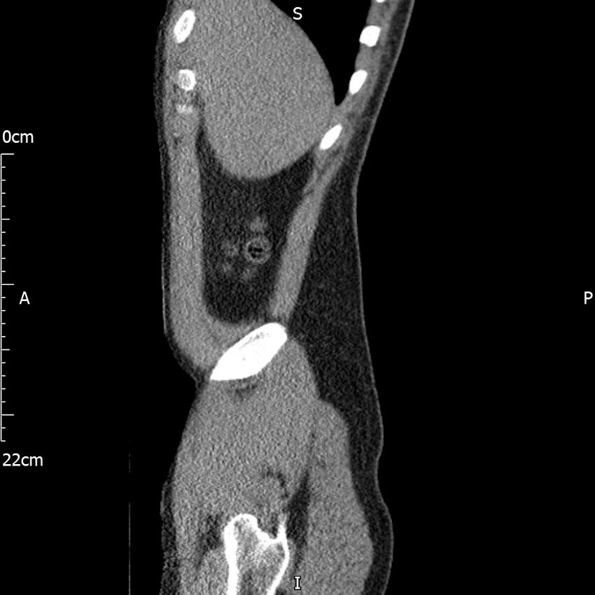 Bilateral medullary nephrocalcinosis with ureteric calculi (Radiopaedia 71269-81569 C 99).jpg