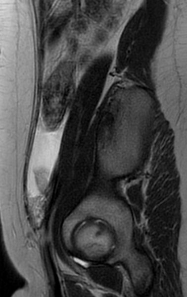 File:Bilateral ovarian fibrothecomas - adolescent (Radiopaedia 86604-102707 Sagittal T2 6).jpg