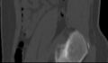 Bilateral pars defect (Radiopaedia 26691-26846 Sagittal bone window 58).jpg
