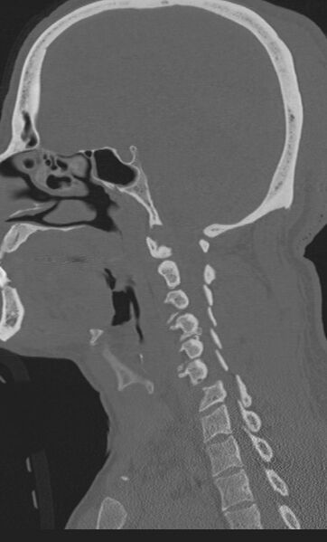 File:Bilateral perched facet joint (Radiopaedia 63149-71669 Sagittal bone window 17).jpg