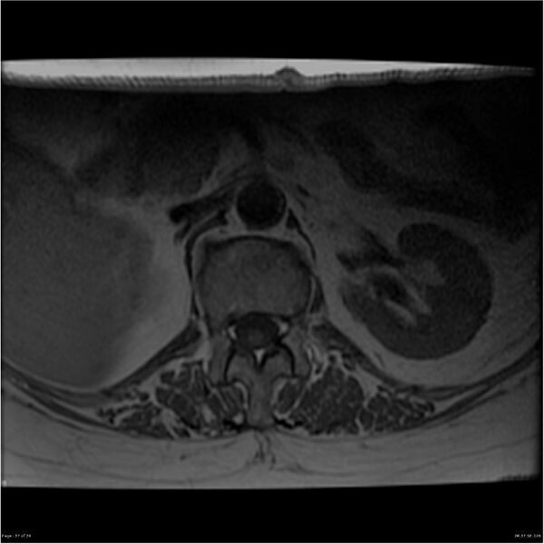 File:Bilateral psoas hematomas (Radiopaedia 24057-24280 T1 37).jpg