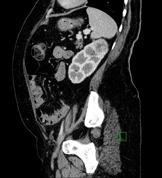 File:Bilateral sporadic synchronous clear cell renal cell carcinoma (Radiopaedia 85035-100575 G 31).jpg