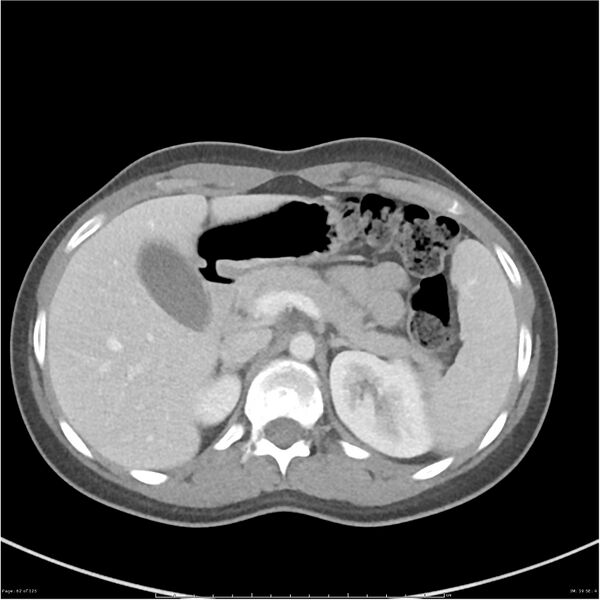 File:Bilateral ureteritis and cystitis (Radiopaedia 25340-25594 A 19).jpg