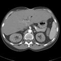 Biliary necrosis - liver transplant (Radiopaedia 21876-21845 A 18).jpg