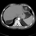 Biliary necrosis - liver transplant (Radiopaedia 21876-21845 A 9).jpg