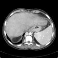 Biliary necrosis - liver transplant (Radiopaedia 21876-21846 B 11).jpg