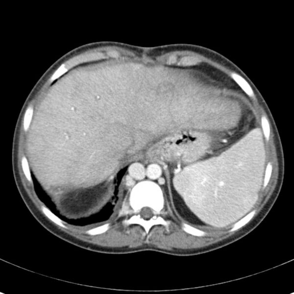File:Biliary necrosis - liver transplant (Radiopaedia 21876-21846 B 11).jpg