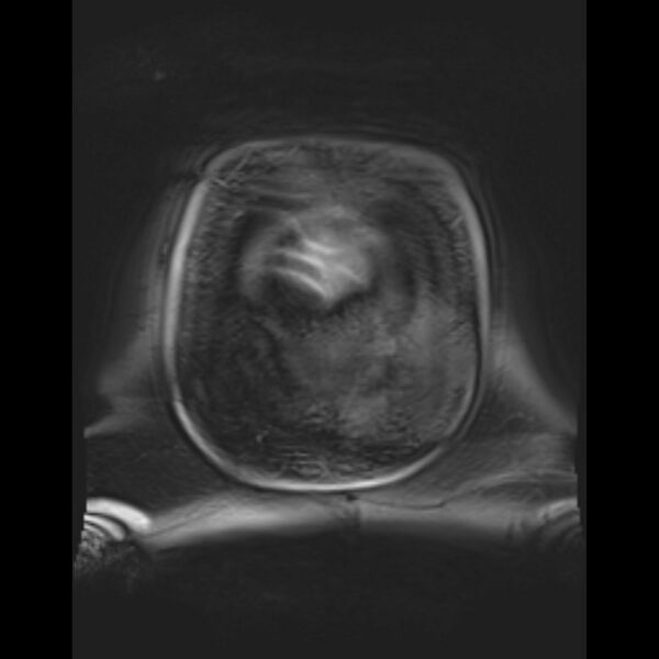 File:Bilobed placenta accreta (Radiopaedia 69648-79591 Coronal T1 vibe 8).jpg