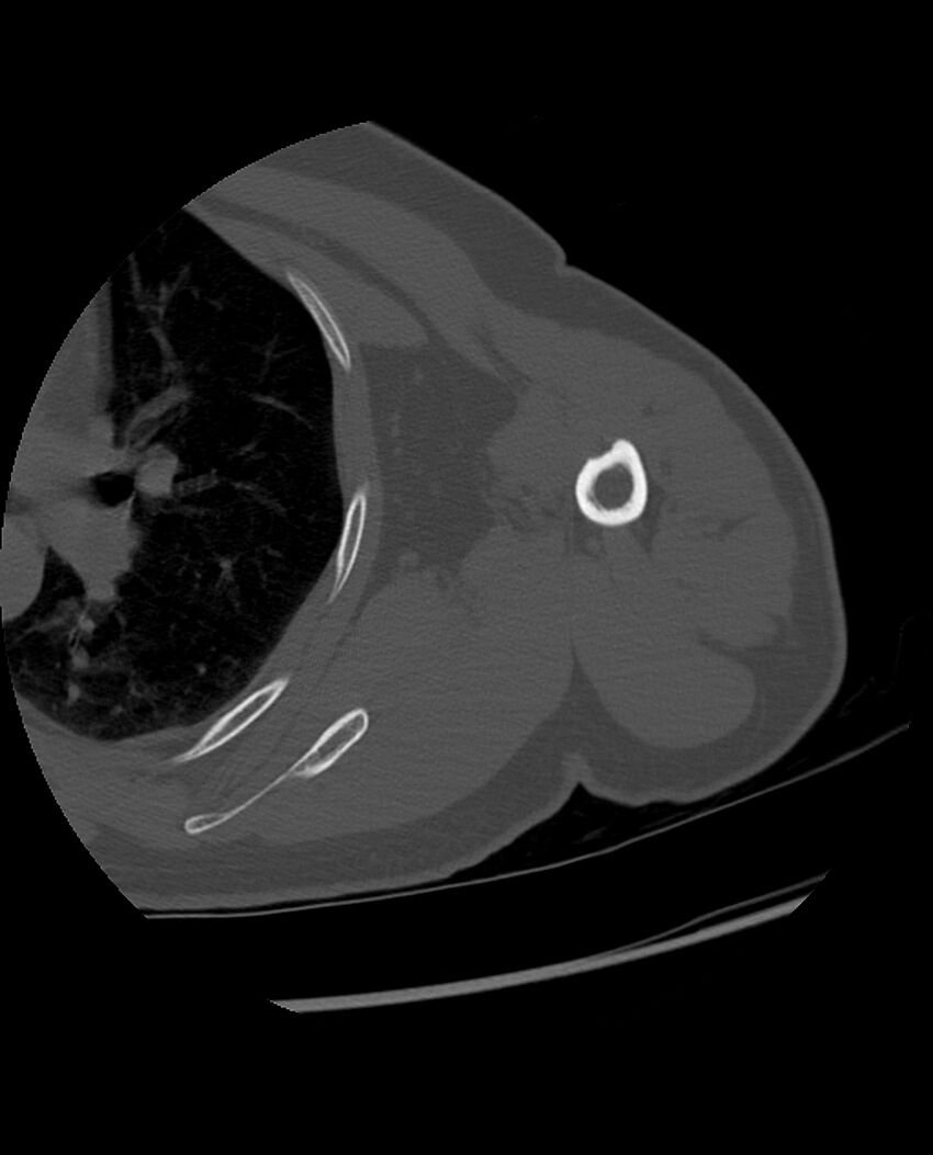 Bizarre parosteal osteochondromatous proliferation (Radiopaedia 84221-99501 Axial bone window 41).jpg