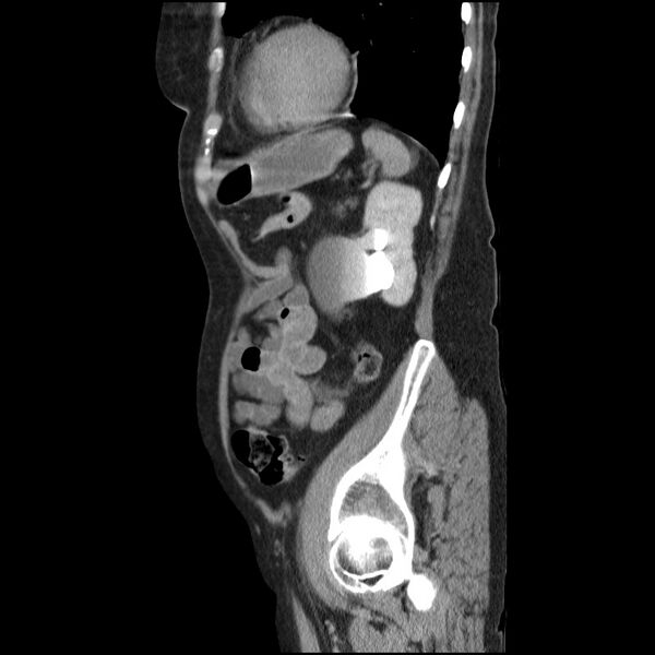 File:Bladder tumor detected on trauma CT (Radiopaedia 51809-57609 E 18).jpg