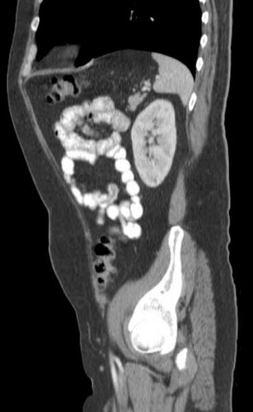File:Bleeding duodenal ulcer and adenomyomatosis of gallbladder (Radiopaedia 61834-69861 C 78).jpg