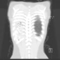 Bochdalek diaphragmatic hernia (Radiopaedia 38866-41059 Coronal lung window 19).jpg