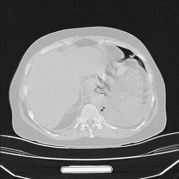 File:Boerhaave syndrome (Radiopaedia 45644-49799 Axial lung window 96).jpg