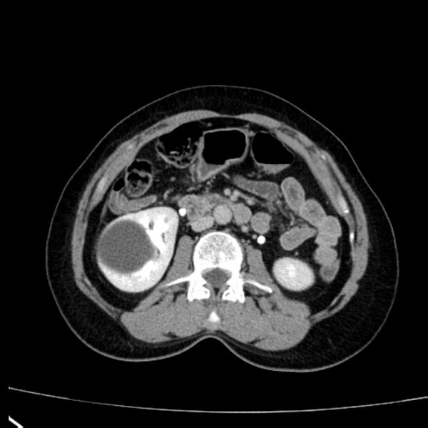File:Bosniak renal cyst - type I (Radiopaedia 27479-27675 D 23).jpg