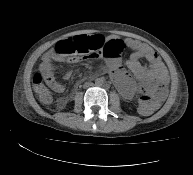 File:Bowel lymphoma complicated by bleeding after therapy (Radiopaedia 55601-62110 Axial non-contrast 42).jpg