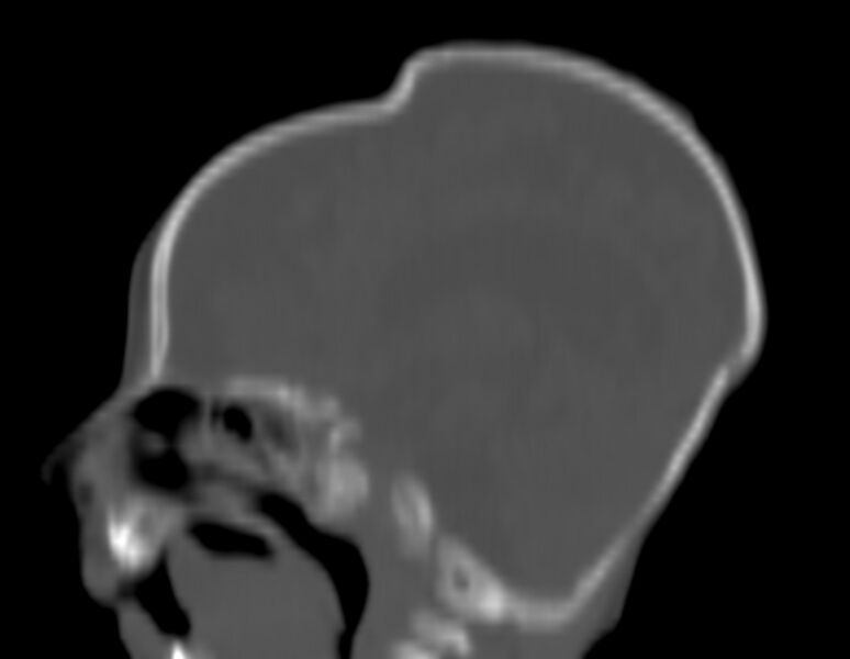 File:Brachycephaly (bi-coronal and bi-lambdoid synostosis) (Radiopaedia 55048-61413 Sagittal bone window 15).jpg