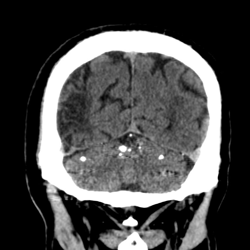 Brain Pantopaque remnants (Radiopaedia 78403-91048 Coronal non-contrast 56).jpg